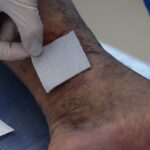 پانسمان نقره (Silver Dressing) چیست؟ انقلابی در درمان زخمهای عفونی و مزمن در کلینیک زخم قم