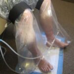 خلاء درمانی زخم (NPWT): راهکار نوین برای ترمیم زخمهای عمیق و مزمن در کلینیک زخم قم